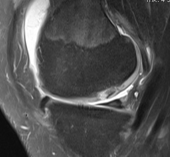 Knee MRI type 4